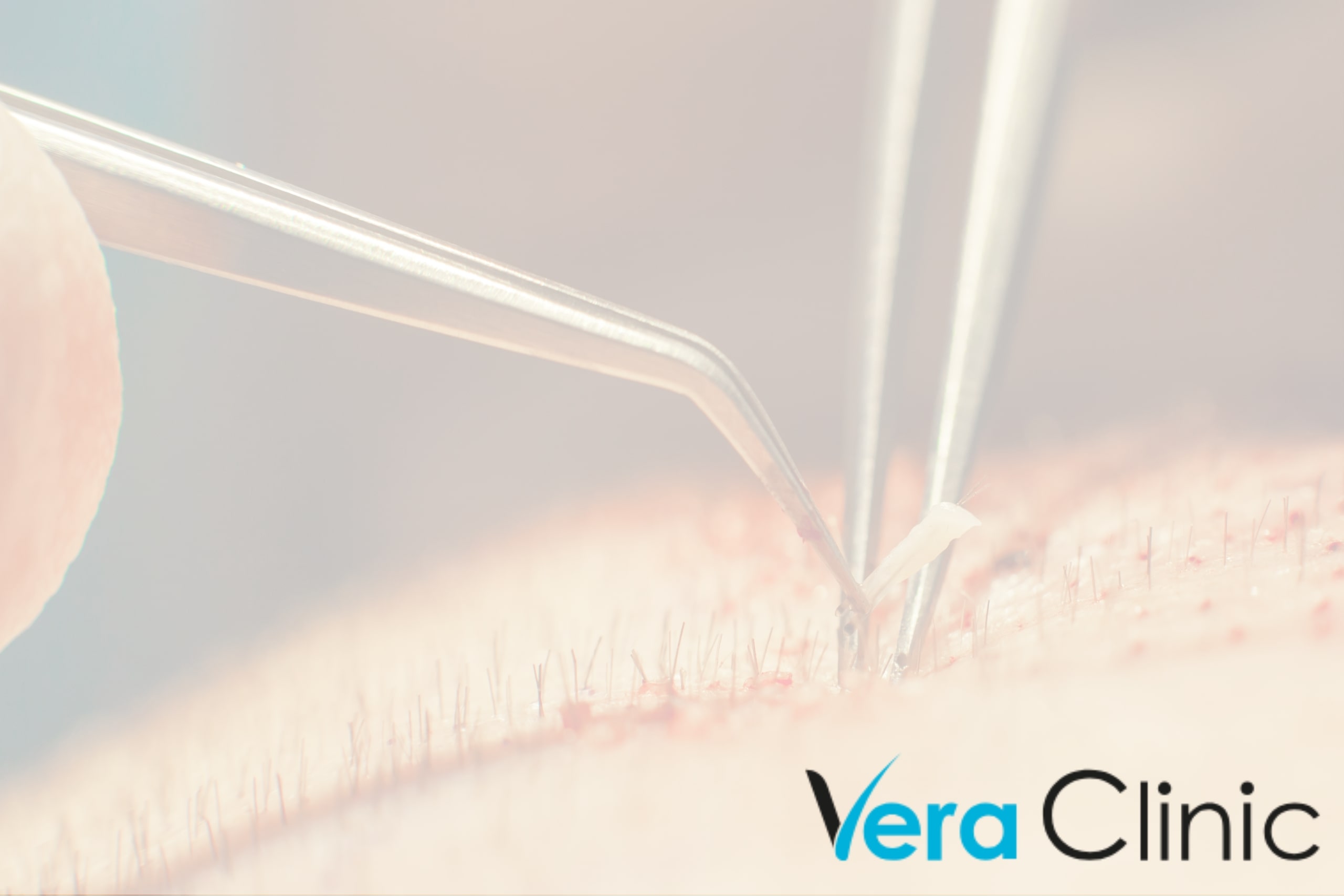 The Rise Of Medical Tourism: Hair Transplants In Turkey